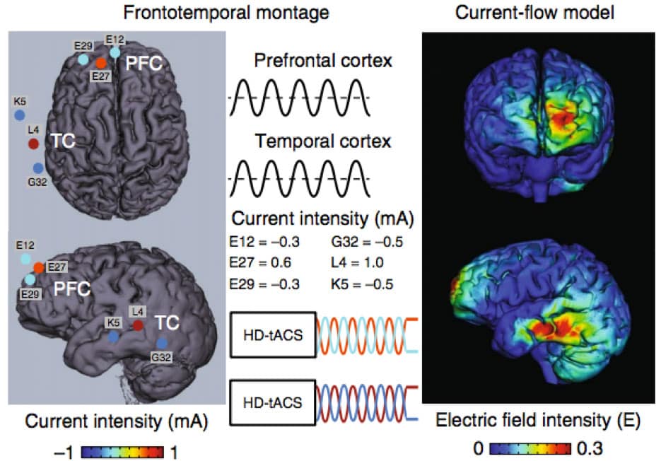 Frontotemporal montage and current-flow model used to target personalized qpTMS™ treatment